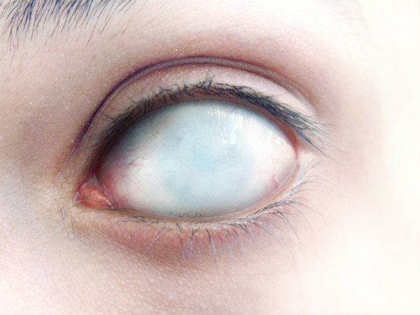 blind-eye01